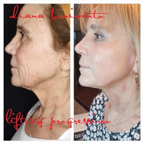 fili piu plasma freddo viso antirughe