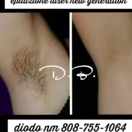 Epilazione Laser